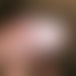 Lichen sclerosus et atrophicus. multiple, chronically dynamic (growth since 1 year), 0.2-1.0 cm l...