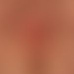 Lichen sclerosus et atrophicus: discrete infestation of the clitoris region; distinct infestation...
