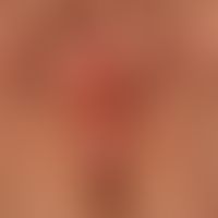 Lichen sclerosus et atrophicus: diskreter Befall der Clitorisregion; deutlicher Befall der Dammre...