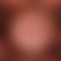Lichen sclerosus:&nbsp;schwerer Befall von Glans penis und Präputium. Deutliche Phimose.
