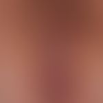 Lichen sclerosus et atrophicus: Severe perianal and vulvar infestation with speckled pattern of s...