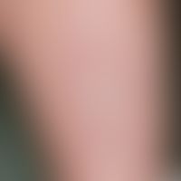 Lichen simplex chronicus: For about one year persistent, strongly itching, clearly infiltrated pl...