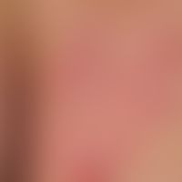 Lichen simplex chronicus, detail enlargement: Strongly itchy, hemp grain-sized, solid, sharply de...