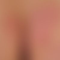 Lichen simplex chronicus. detail enlargement: Strongly itchy, 0.1-0.2 cm large, solid, sharply de...