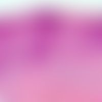 Lichen simplex chronicus. pronounced acanthosis with irregular elongation of the reticules. moder...
