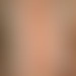 Lichtdermatosen. Lichttreppe: Erytheme in allen Bestrahlungsfeldern der UVA- und UVB-Testreihe. E...