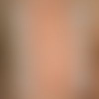 Lichtdermatosen. Lichttreppe: Erytheme in allen Bestrahlungsfeldern der UVA- und UVB-Testreihe. E...