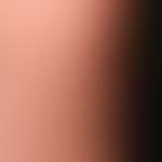 Lichtdermatose, polymorphe. Ein- bis zweimal jährlich nach der ersten Sonneneinstrahlung auftrete...