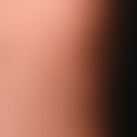 Lichtdermatose, polymorphe. Ein- bis zweimal jährlich nach der ersten Sonneneinstrahlung auftrete...