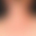 Lichtdermatose, polymorphe. Übersichtsaufnahme: Multiple, juckende, hochrote Papeln, teilweise zu...