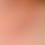 Lichtdermatose, polymorphe. Detailvergrößerung: Multiple, juckende, hochrote Papeln, teilweise zu...