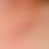 Lichtdermatose, polymorphe. Detailvergrößerung: Multiple, juckende, hochrote Papeln, teilweise zu...
