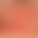 Lichtdermatose, polymorphe. Detailvergrößerung: Multiple, juckende, hochrote Papeln, teilweise zu...