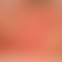 Light dermatosis, polymorphic. detail enlargement: multiple, itchy, highly red papules, partly co...