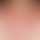 Lichturtikaria. Flächige urtikarielle Reaktion im Dekolletébereich, wenige Minuten nach Sonnenexp...