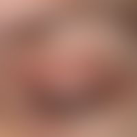 Kontaktallergisches Lidekzem. Exazerbation der Hautveränderungen nach&nbsp; Auftragen von Lidkosm...
