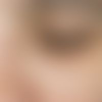 Atopisches Liddermatitis: Geringe dermatitische Reaktion. Auffällig die&nbsp; deutlich ausgeprägt...