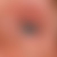 Atopische Liddermatitis:&nbsp;atopische Liddermatitis bei einem 62-jährigen Mann, mit deutlicher ...
