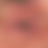 Atopische Liddermatitis: chronisch rezidivierendes atopisches Lidekzem mit unscharf begrenzten, d...