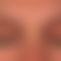 Kontaktallergische Dermatitis der Lider: chronisch rezidivierende Dermatitis mit erheblichem und ...