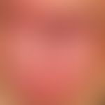 Lingua plicata:&nbsp;rote, glatte Zunge mit angeborener, symptomloser, verstärkter Längsfurchung ...