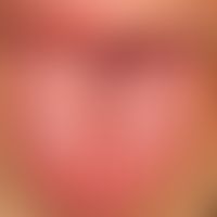 Lingua plicata:&nbsp;rote, glatte Zunge mit angeborener, symptomloser, verstärkter Längsfurchung ...