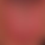 Lingua plicata:&nbsp;körniger Zungenbelag in den zentralen Partien der Zunge. Lingua plicata mit ...