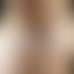Lipoatrophie, lokalisierte nach Glukokortikosteroid-Injektionen. 27 Jahre alte "Heuschnupfenpatie...