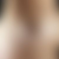 Lipoatrophie, lokalisierte nach Glukokortikosteroid-Injektionen. 27 Jahre alte "Heuschnupfenpatie...