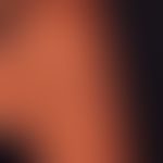 Lipoatrophie, lokalisierte Glukokortikosteroid-Injektionen. Fettgewebsatrophie durch eine vor 6 M...