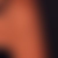 Lipoatrophie, lokalisierte Glukokortikosteroid-Injektionen. Fettgewebsatrophie durch eine vor 6 M...