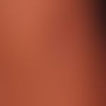 Lipoatrophie, lokalisierte Glukokortikosteroid-Injektionen. Fettgewebsatrophie durch eine vor 6 M...