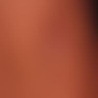 Lipoatrophie, lokalisierte Glukokortikosteroid-Injektionen. Fettgewebsatrophie durch eine vor 6 M...