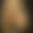 Lipodystrophia generalisata acquisita. Lipoatrophie der Extremitäten, vermehrte Fetteinlagerung a...