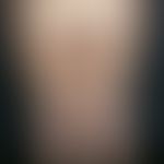 Lipödem:&nbsp;beidseitige, zunächst schmerzlose, nach jahrelangem Bestand schmerzhafte, symmetris...
