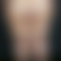 Lipödem:&nbsp;beidseitige, zunächst schmerzlose, nach jahrelangem Bestand schmerzhafte, symmetris...