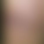 Lipogranulomatosis subcutanea. Druckschmerzempfindliche, kutan-subkutan gelegene, walnussgroße Kn...
