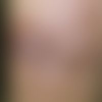 Lipogranulomatosis subcutanea. Druckschmerzempfindliche, kutan-subkutan gelegene, walnussgroße Kn...