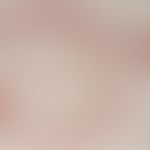 Lipoma - General magnification: A septated adipose tissue tumour of mature adipocytes surrounded ...