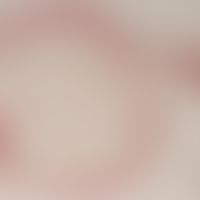 Lipoma - General magnification: A septated adipose tissue tumour of mature adipocytes surrounded ...