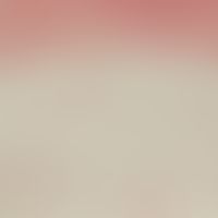 Lipoma. detail magnification: At the upper edge of the image, part of the connective tissue capsu...