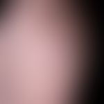 Lipoma: A subcutaneous lump on the shoulder that has existed for years, is completely unattractiv...