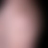 Lipoma: A subcutaneous lump on the shoulder that has existed for years, is completely unattractiv...