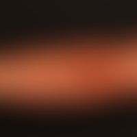 Lipomas: spherical soft painless tumours that have reached this size over a period of 3-4 years, ...