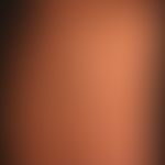 Lipomas: spherical soft painless tumours that have reached this size over a period of 3-4 years; ...