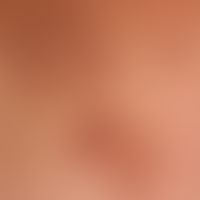 Naevus lipomatosus cutaneus superficialis: Lipomasof the skin with soft protuberant papules and n...