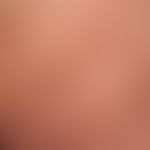 Naevus lipomatosus cutaneus superficialis:multiple lipomas (fatty tissue hamartomas of the skin) ...