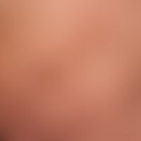 Naevus lipomatosus cutaneus superficialis:multiple lipomas (fatty tissue hamartomas of the skin) ...