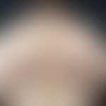 Lipomatosis, benign symmetrical. 67-year-old female patient with continuously increasing lipomato...