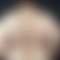 Lipomatose, benigne symmetrische. 67 Jahre alte Patientin mit kontinuierlich zunehmender Lipomato...